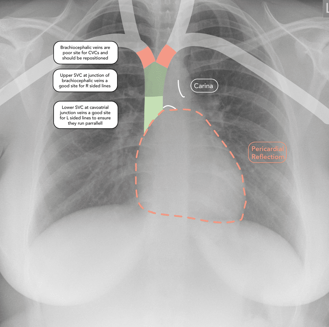 Central Venous Catheter Insertion & Management theguidewire