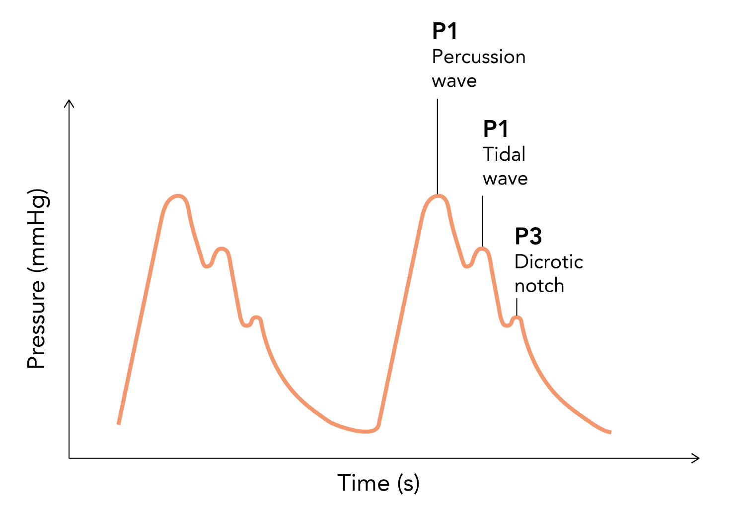 Intracranial Pressure (ICP) Monitoring theguidewire