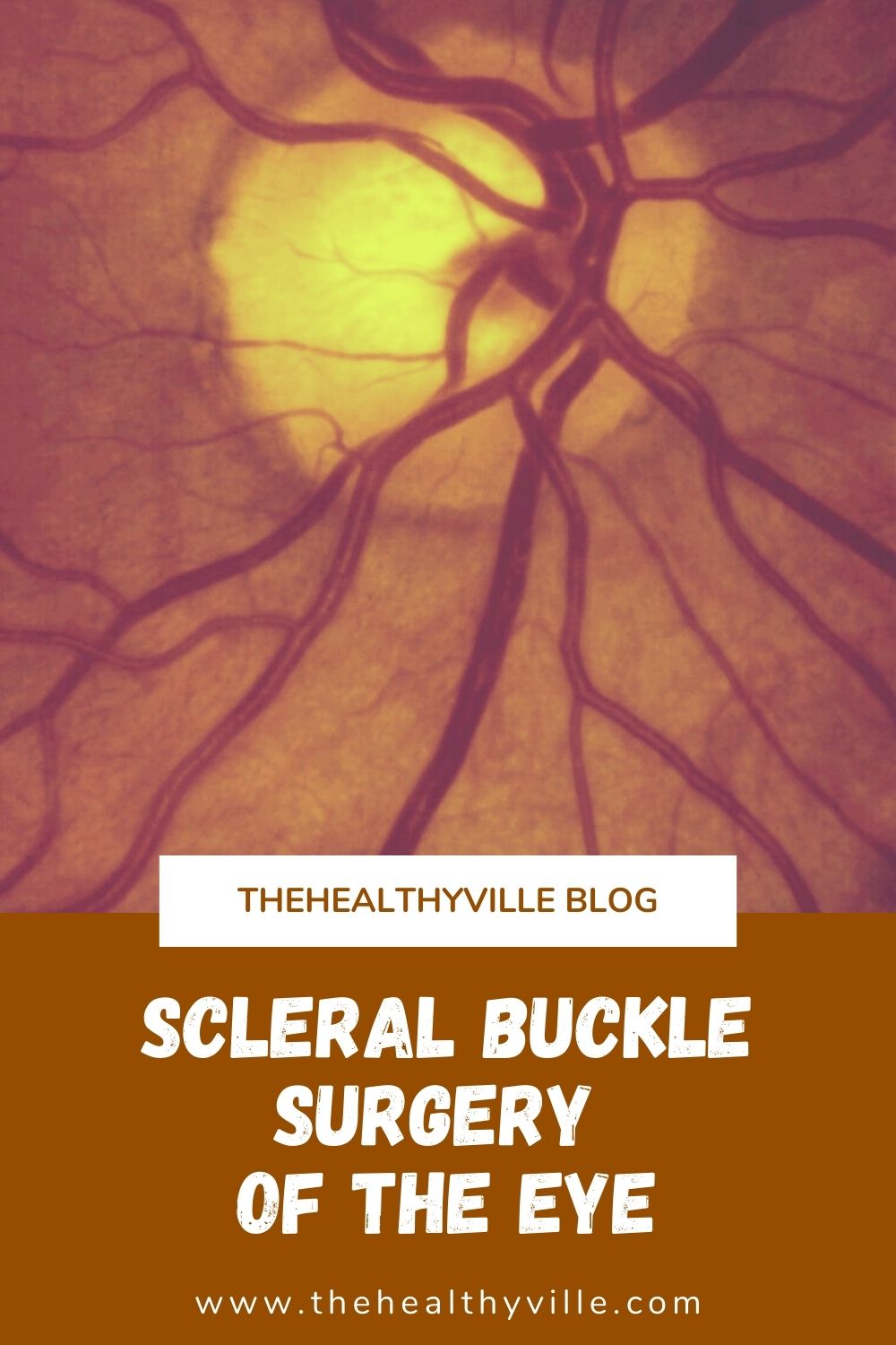Scleral Buckle Surgery of the Eye What Is It and When Is It Needed?
