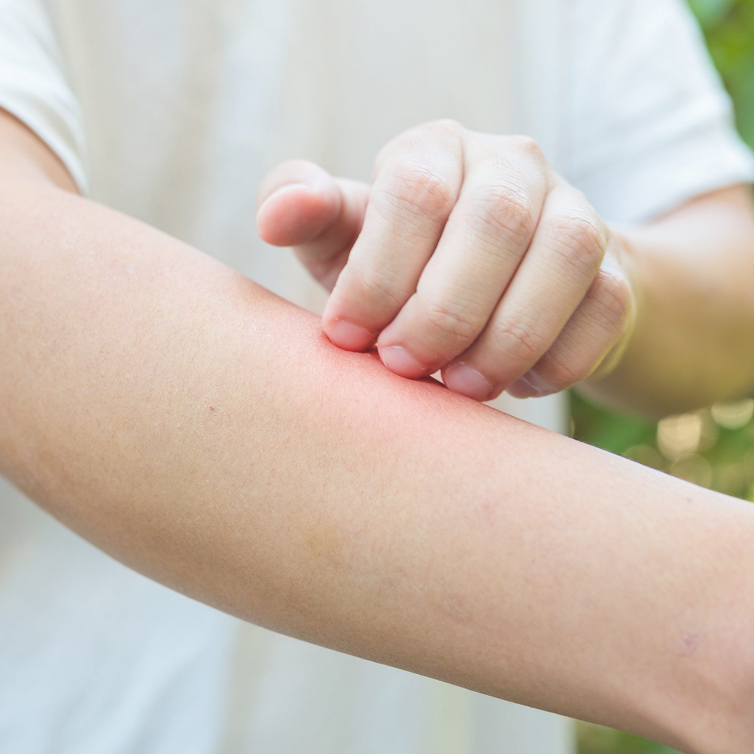 7 Natural Remedies for Insect Sting Allergies The Hidden Cures