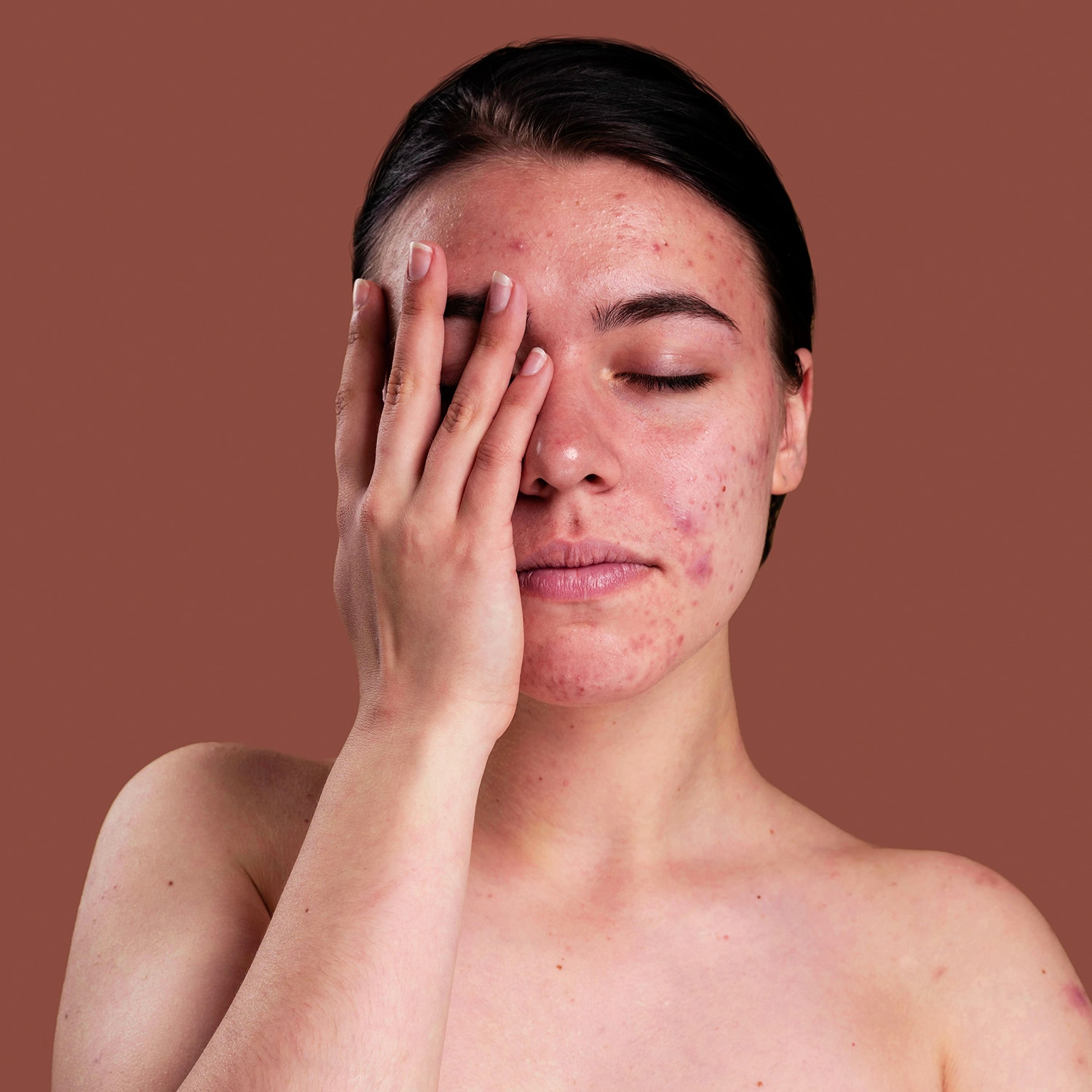 6 Natural Ways Of Getting Rid Of Pimples The Hidden Cures