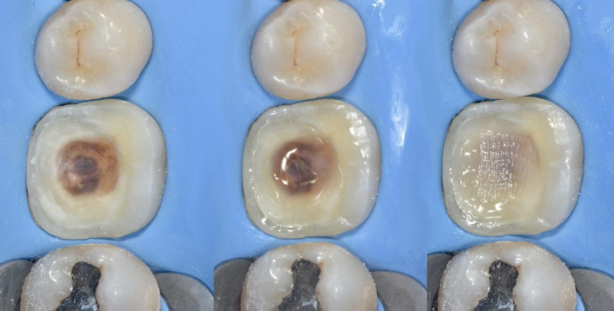 Resin Coating (RC) The Hybrid Layer