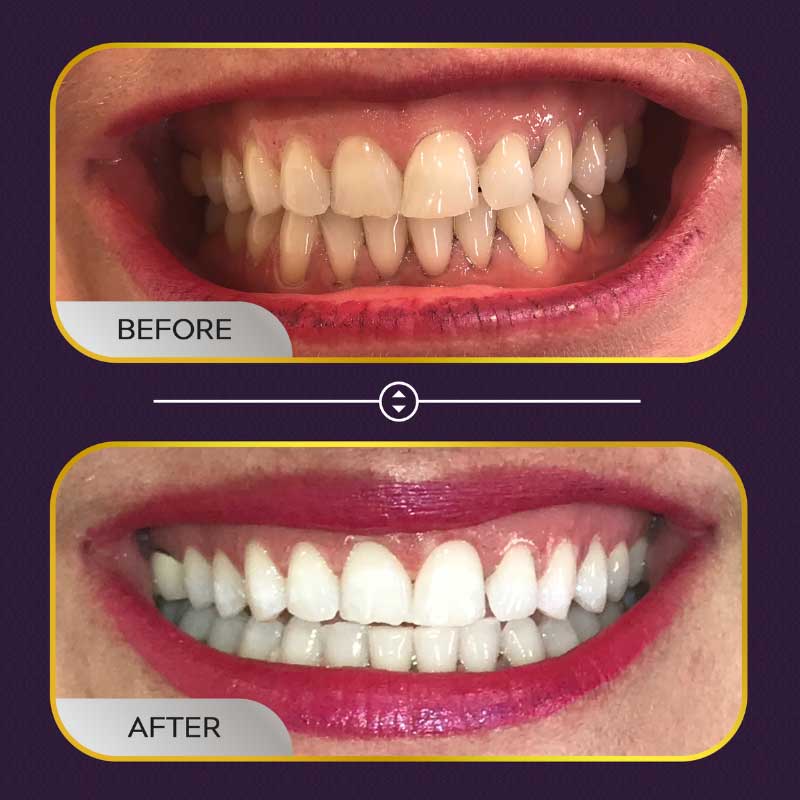 teethwhiteningbeforeandafter01 Mobile Dentist In Detroit Michigan
