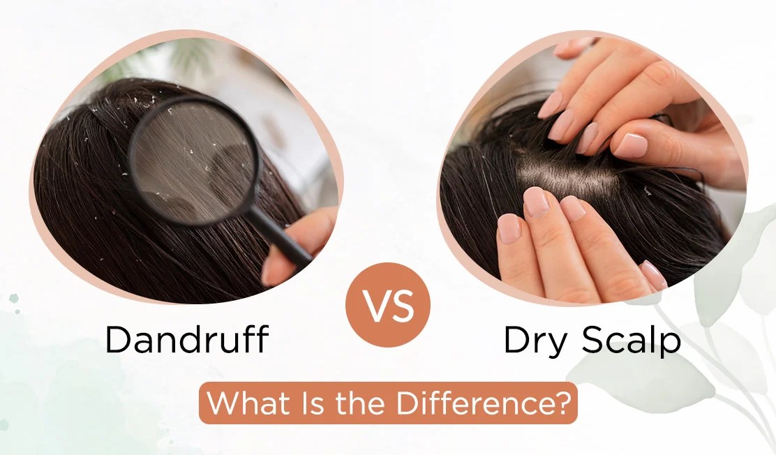 Dandruff Vs Dry Scalp What Is the Difference? The Indie Earth