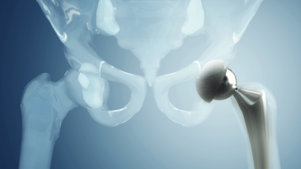 BLOGHip The Jackson Clinics, Physical Therapy