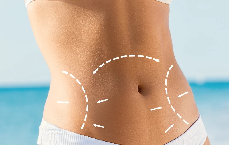 6 Signs of a Bad Tummy Tuck Thejit