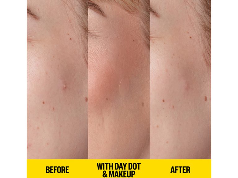 Peace Out Acne Day Dots The Most Invisible Pimple Patches Ever