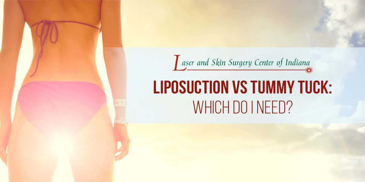Liposuction vs Tummy Tuck Laser and Skin Surgery Center of Indiana