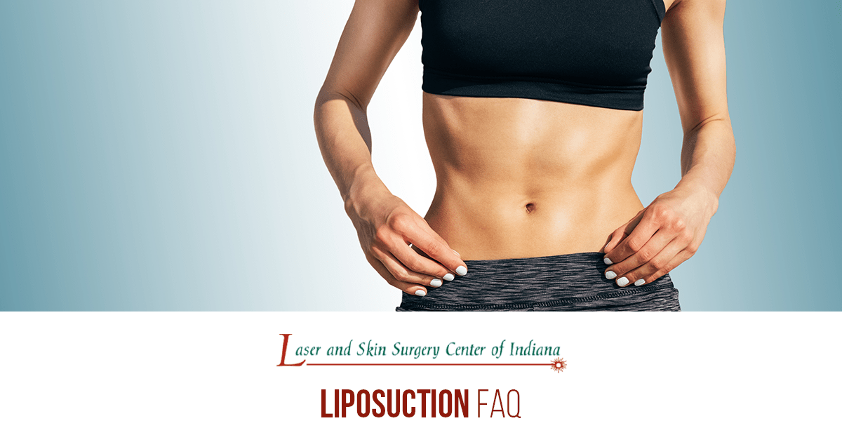 Liposuction FAQ Laser and Skin Surgery Center of Indiana