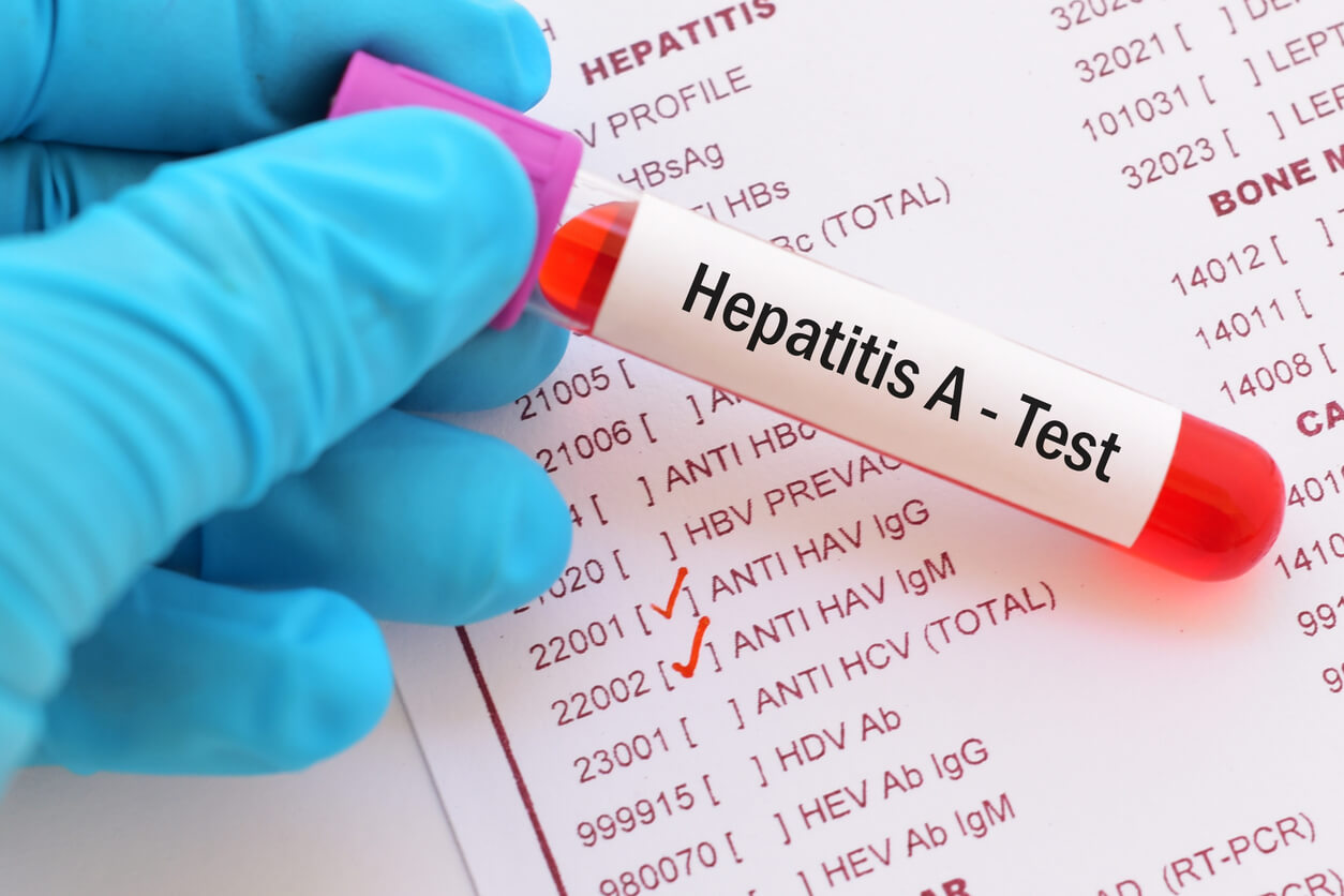 Spike in Hepatitis A cases concerns health professionals