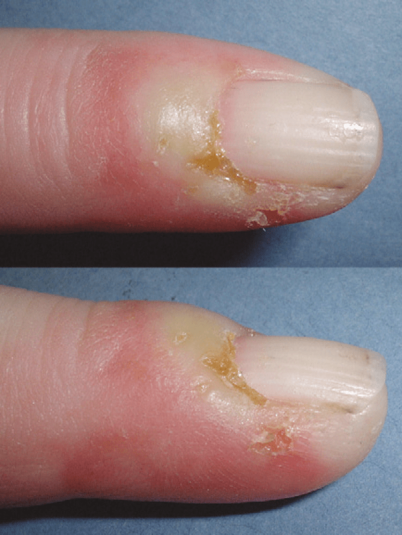 Hand Infections Lothian Virtual Hand Clinic