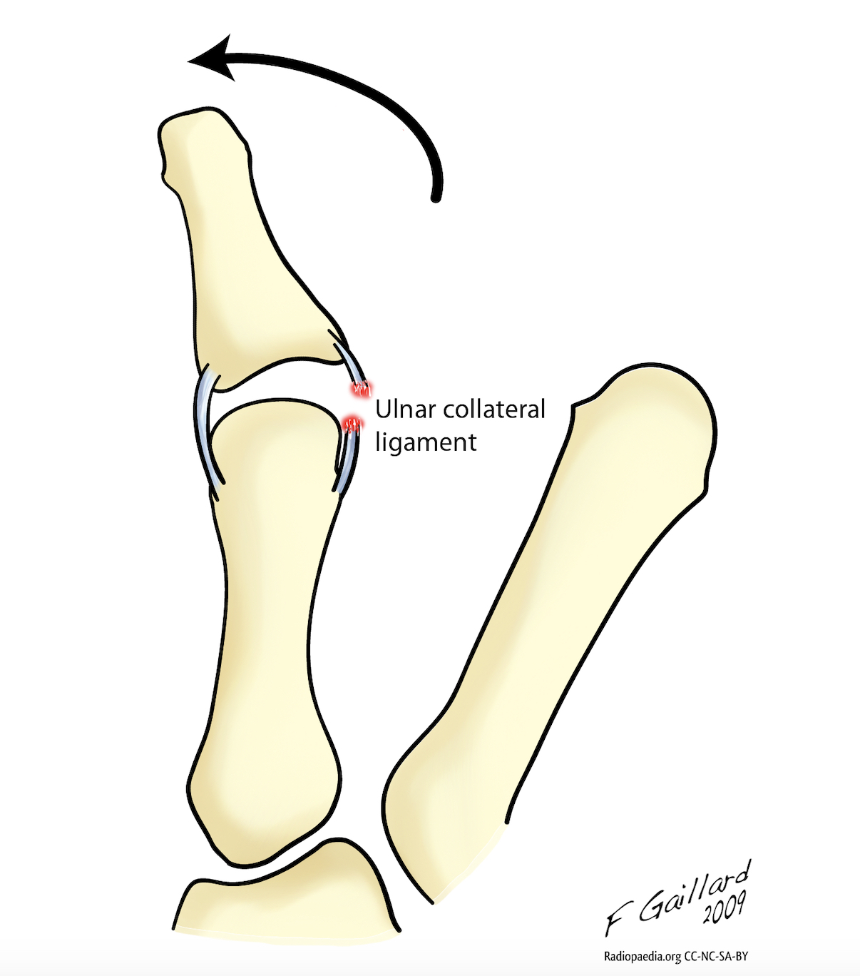 Ulnar collateral ligament (UCL) injury of thumb The Lothian Hand Unit