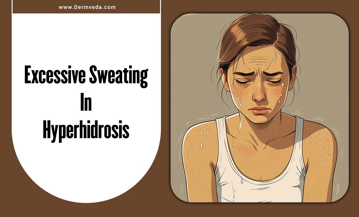 Excessive Sweating In Hyperhidrosis