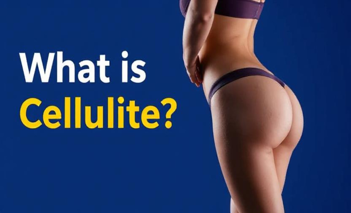 What Is Cellulite