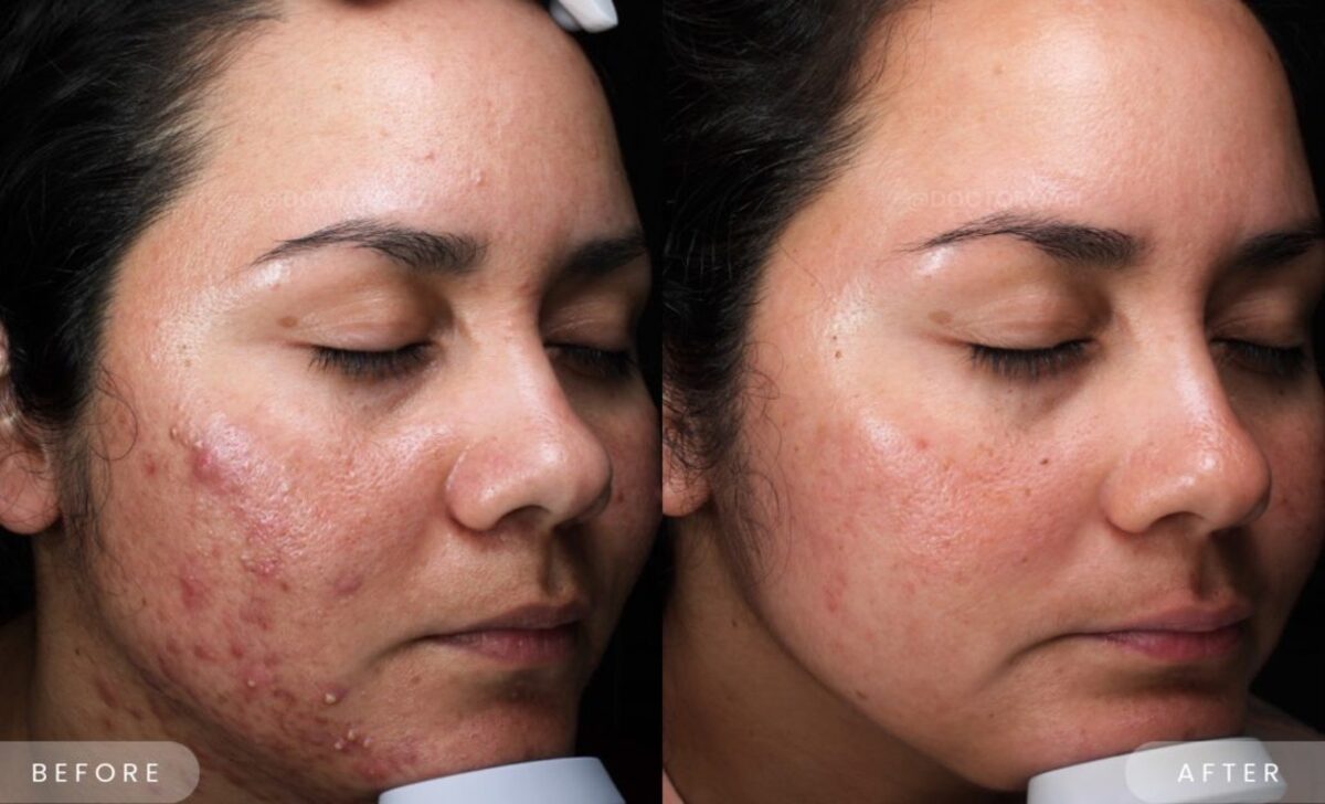 Initial Stages Of Accutane Treatment