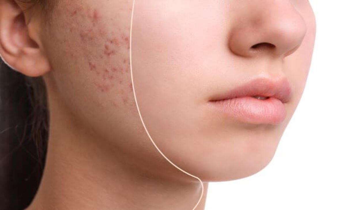 When Is Accutane Recommended