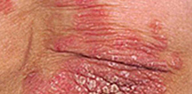how to psoriasis routine