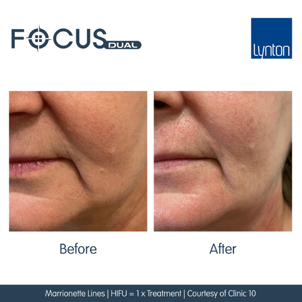 Focus Dual the lunch time face lift explained · HIFU Facial · Lynton