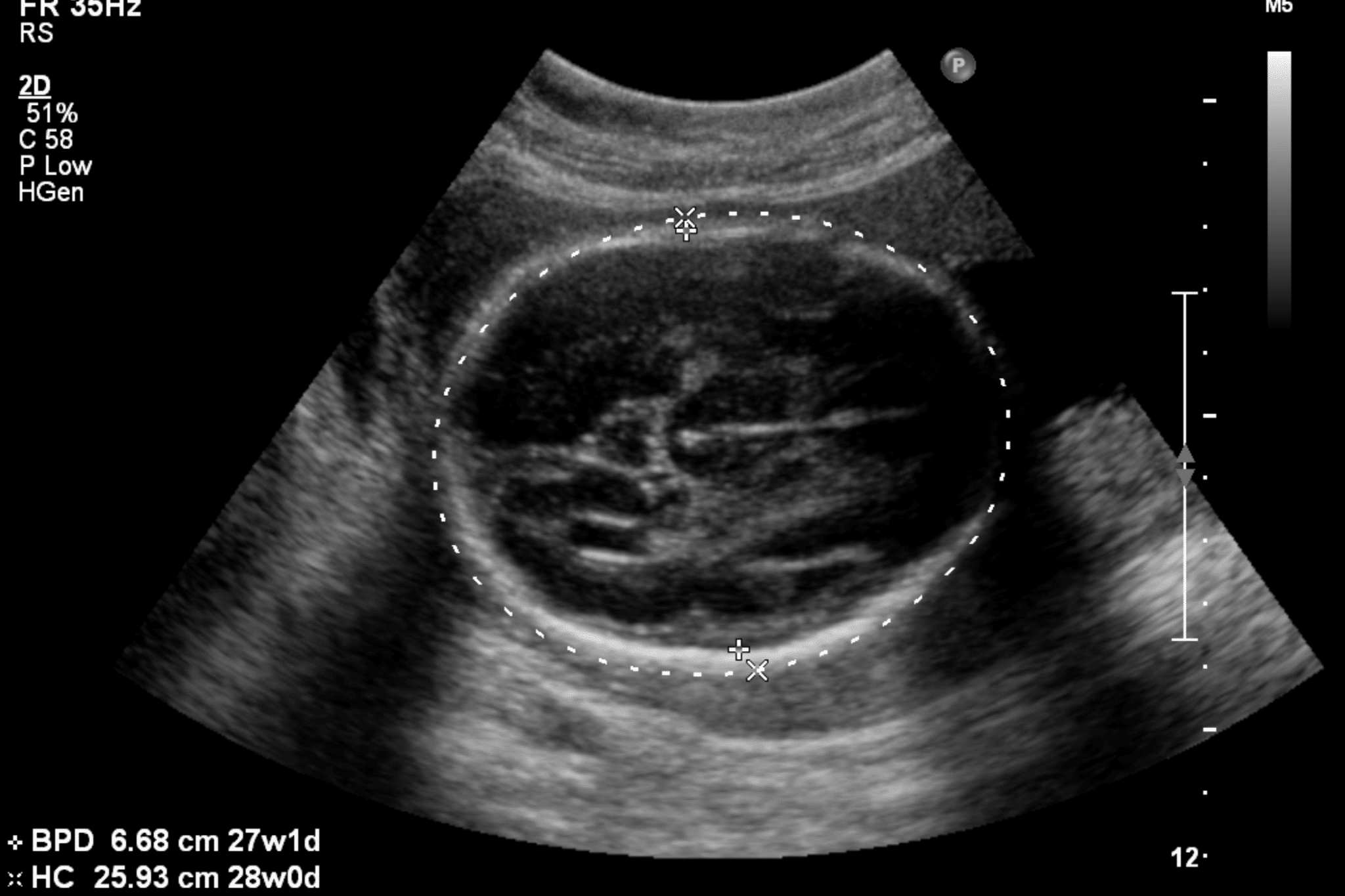 How Accurate Are Dating Ultrasounds Telegraph