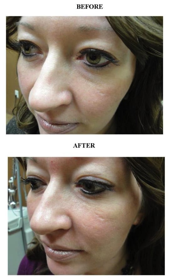 Before & After Fillers Tear Troughs Patient 04 The Medical Spa