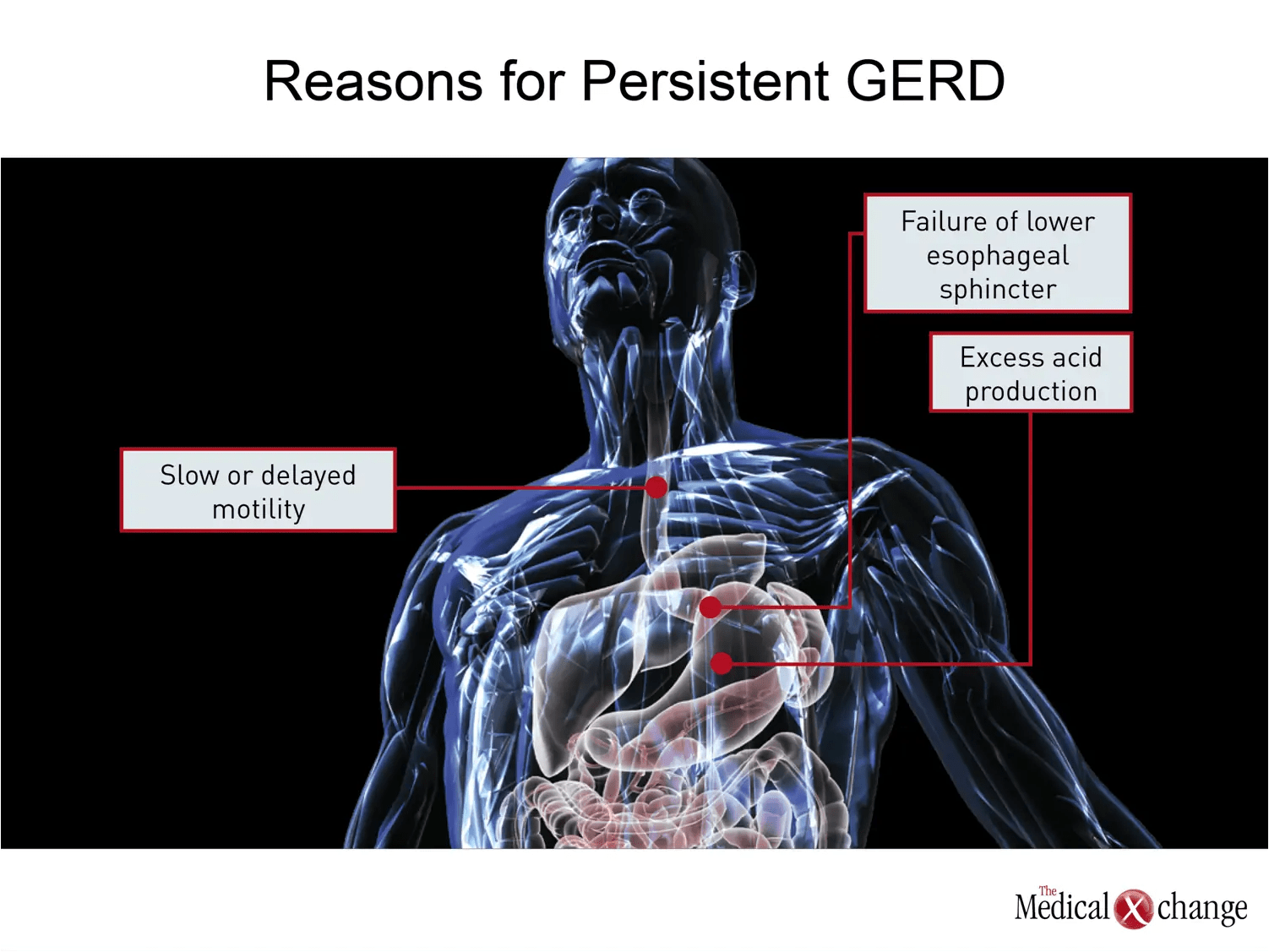 Chapter 3 GERD The Era of PPIs The Medical Xchange