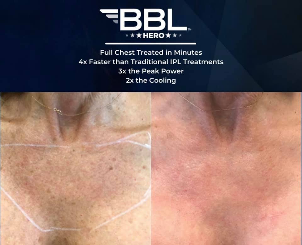 Scrotox Before And After Picture Scrotox Treatment For Men In New(03)