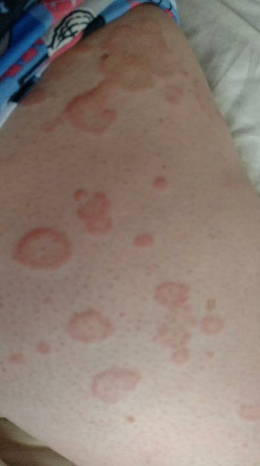 Rash On Outer Thigh