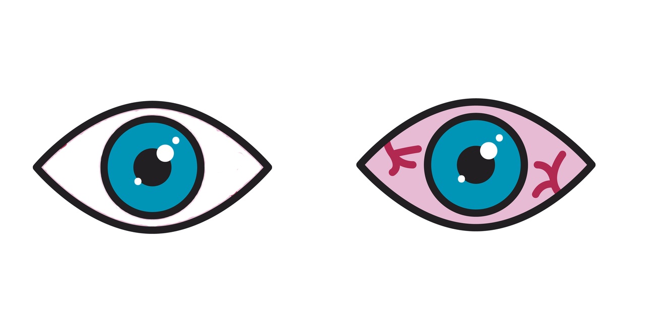 Ophthalmologists Caution Pink Eye a Rare COVID19 Symptom