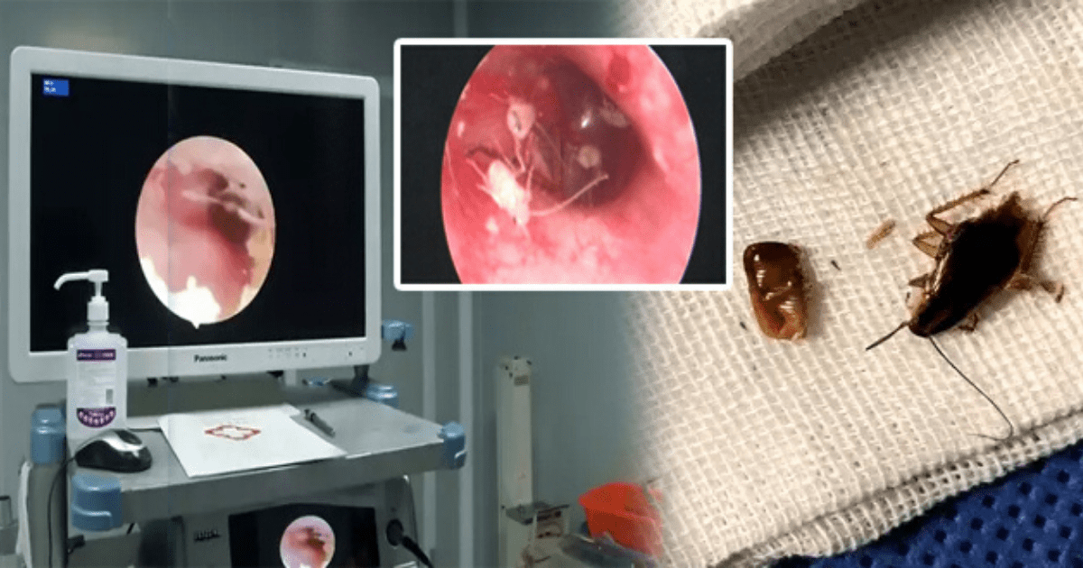 Family of Cockroaches Found Living Inside Man’s Ear