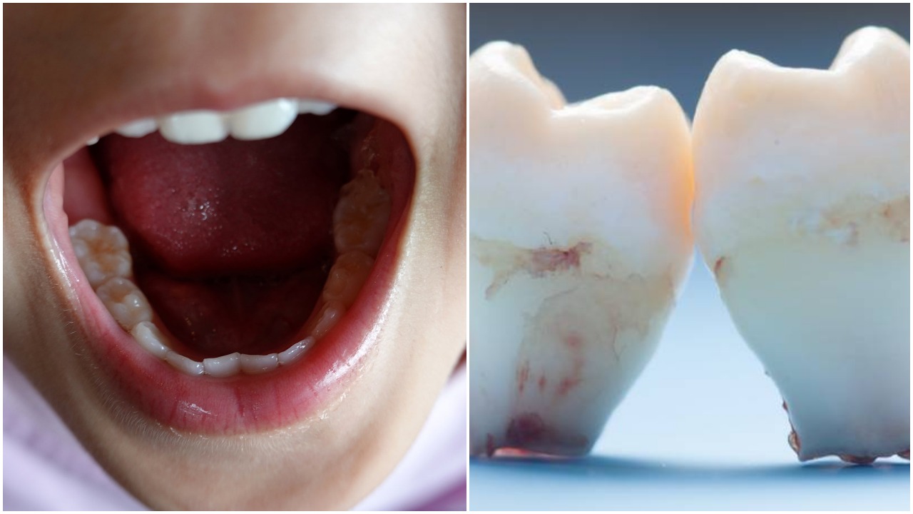 Human "MicroEvolution" Clear as More Babies Born Without Wisdom Teeth And With Extra Artery