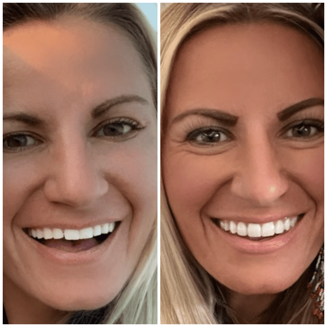 5 Ways I Saved Thousands on Porcelain Veneers Your Affordable Smile