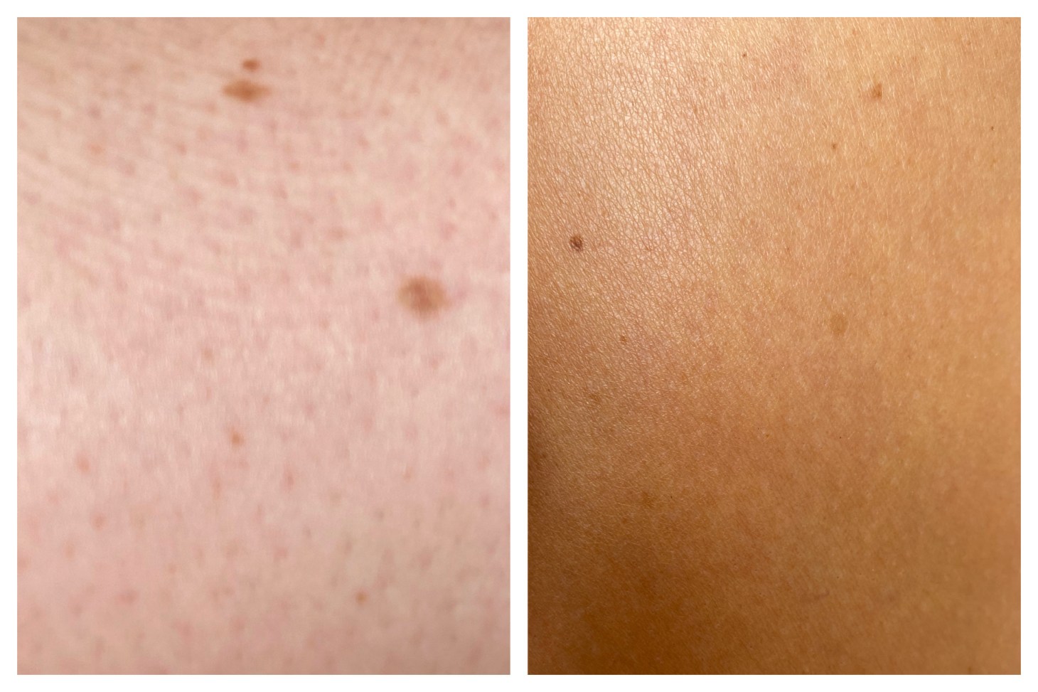 Budget Tips to Treat Strawberry Legs AKA Tiny Black Dots all Over