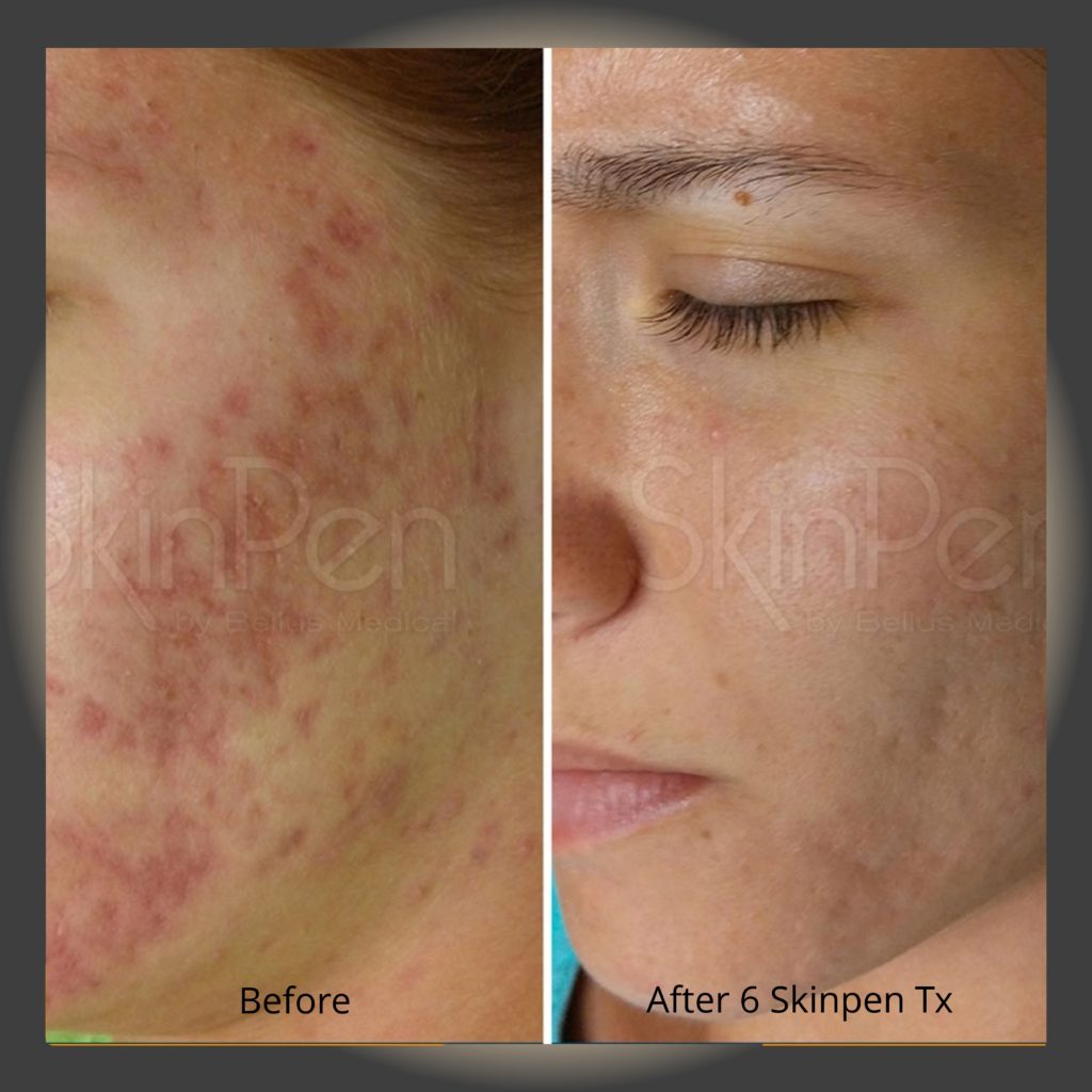 Microneedling in Colorado Springs The New Canvas