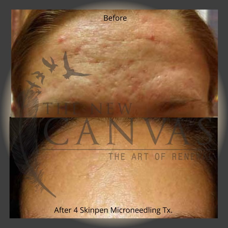 Microneedling in Colorado Springs The New Canvas