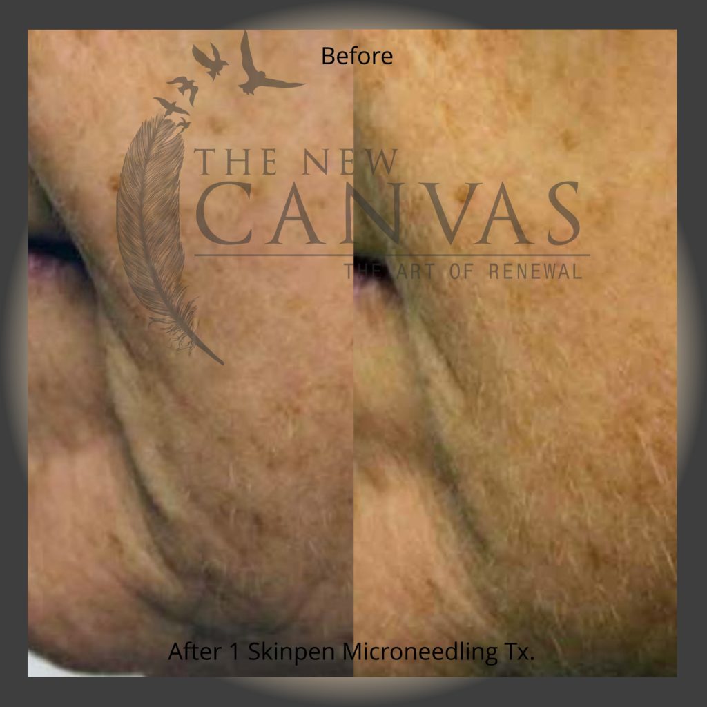 Microneedling in Colorado Springs The New Canvas