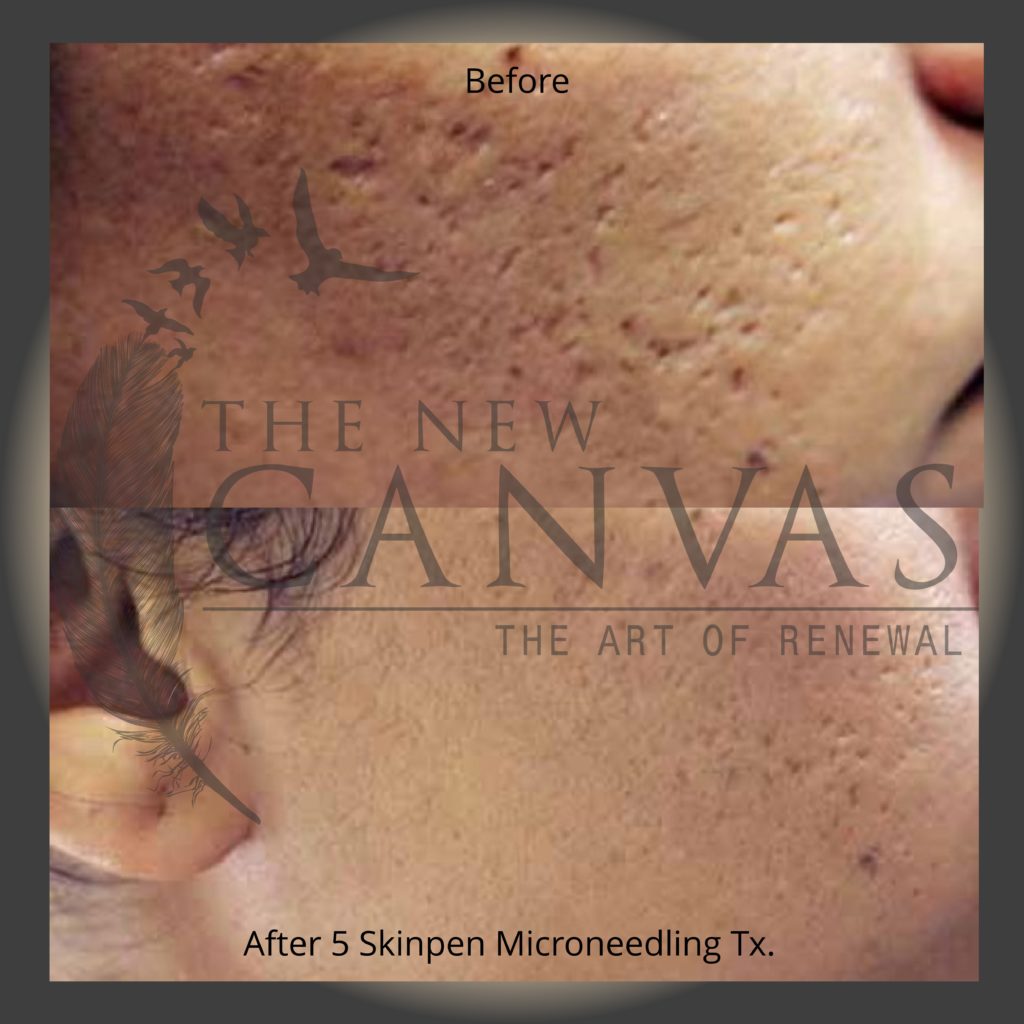 Microneedling in Colorado Springs The New Canvas