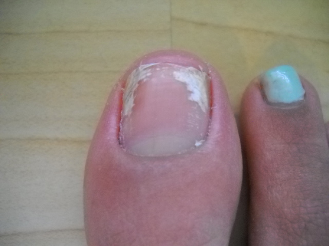 White Spots On Your Nails...? Here is What They Indicate!