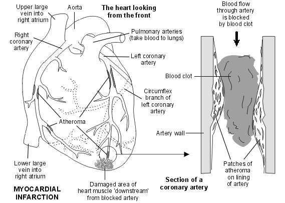 Troponin and Cardiac Events Nurses Zone Source of Resources for Nurses Troponin and Cardiac Events Nurses Zone Source of Resources for Nurses
