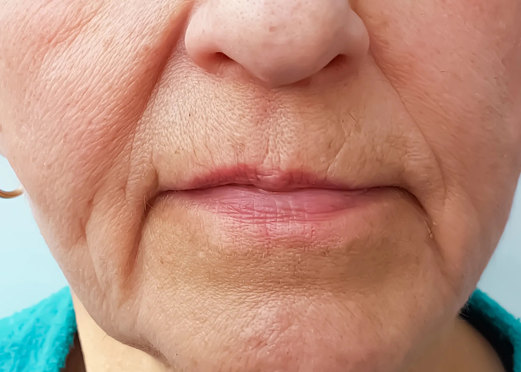 Botox for TMJ Alleviates Pain The Oaks Dental Center