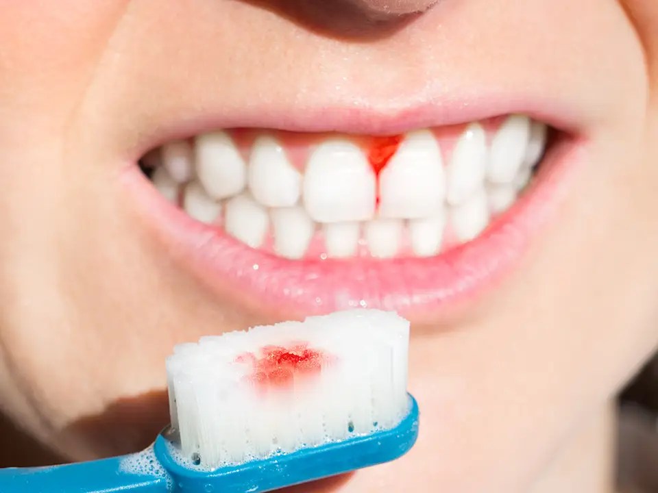 6 Ways How to Improve Your Gum Health The Oaks Dental Center