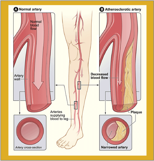 PERIPHERAL ARTERY DISEASE (PAD) PLANNED LONGEVITY™