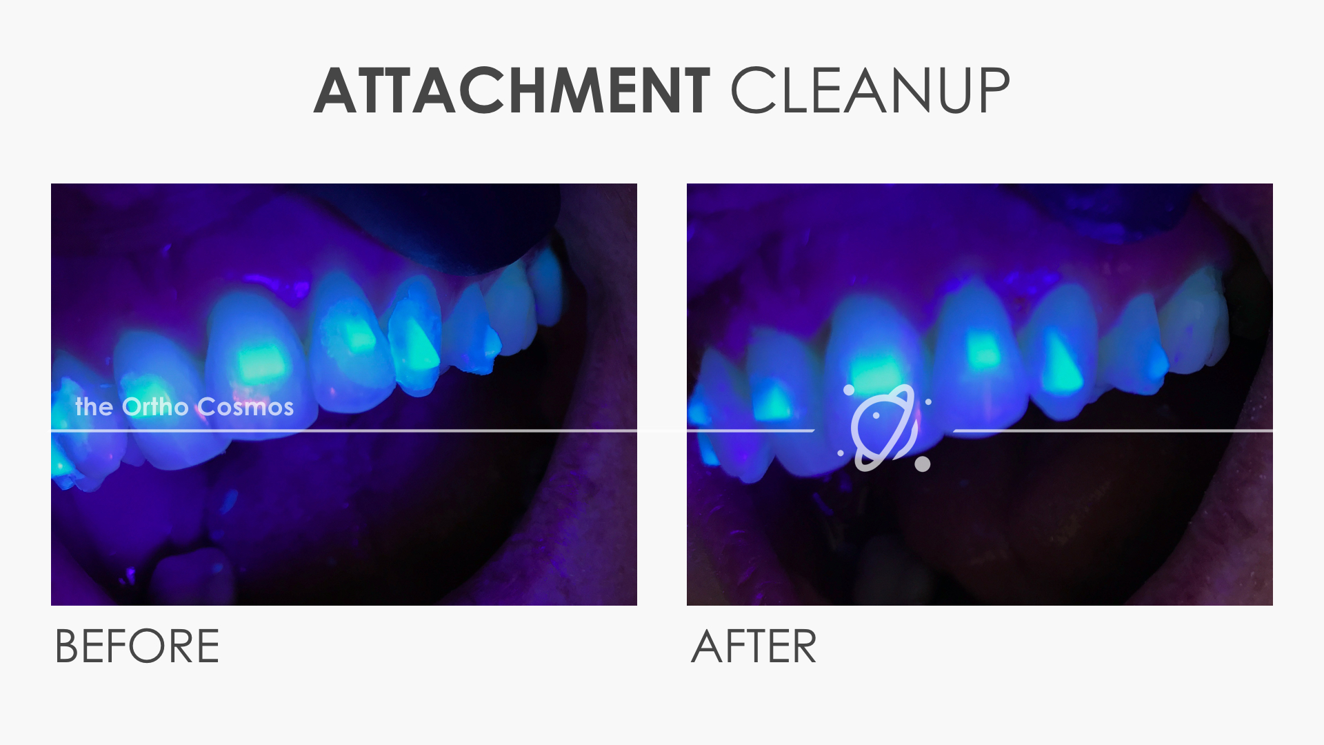 Evaluating Invisalign Tracking & Attachment Flash The Ortho Cosmos