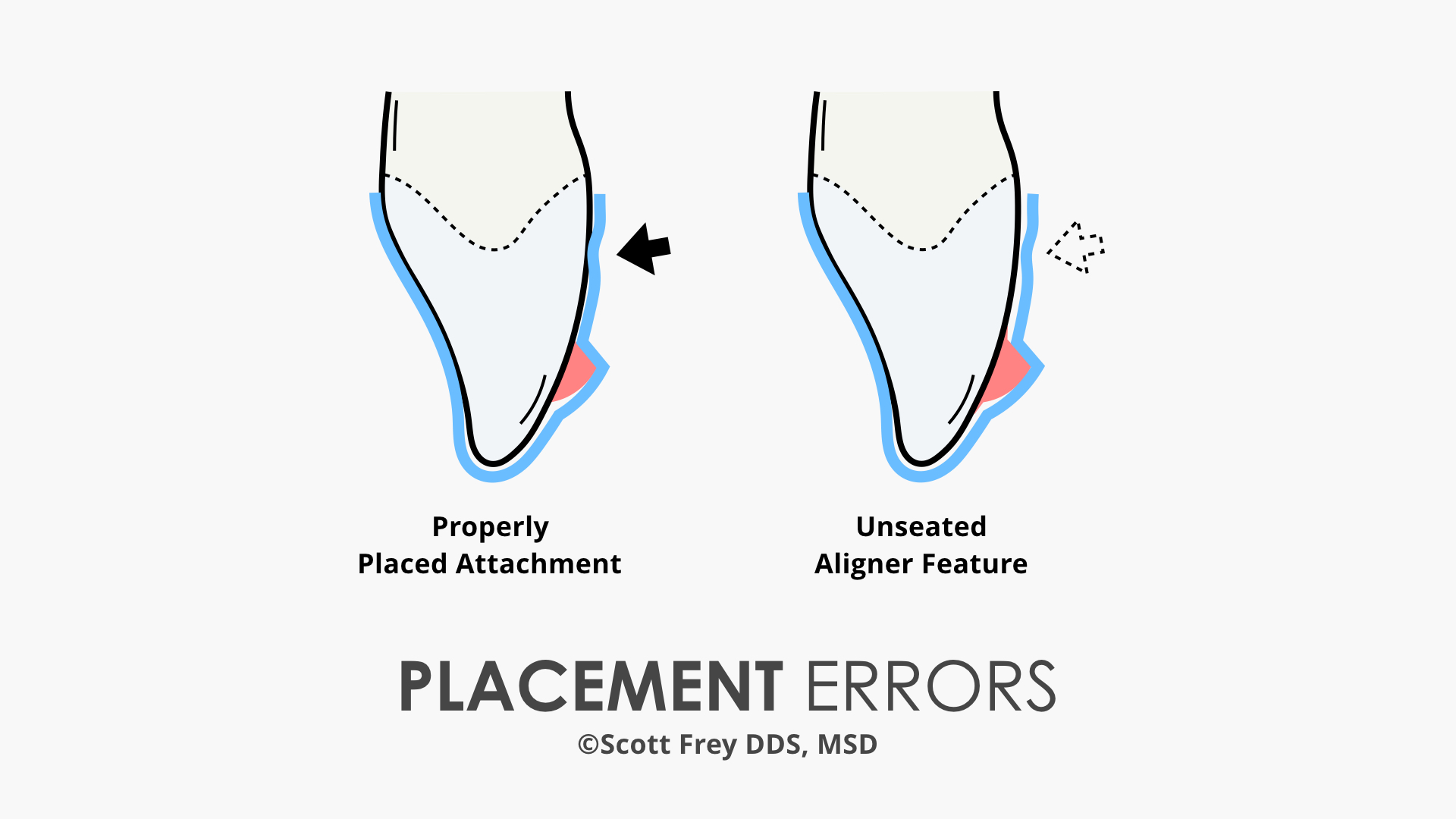 Traditional Attachments vs Aligner Optimization The Ortho Cosmos