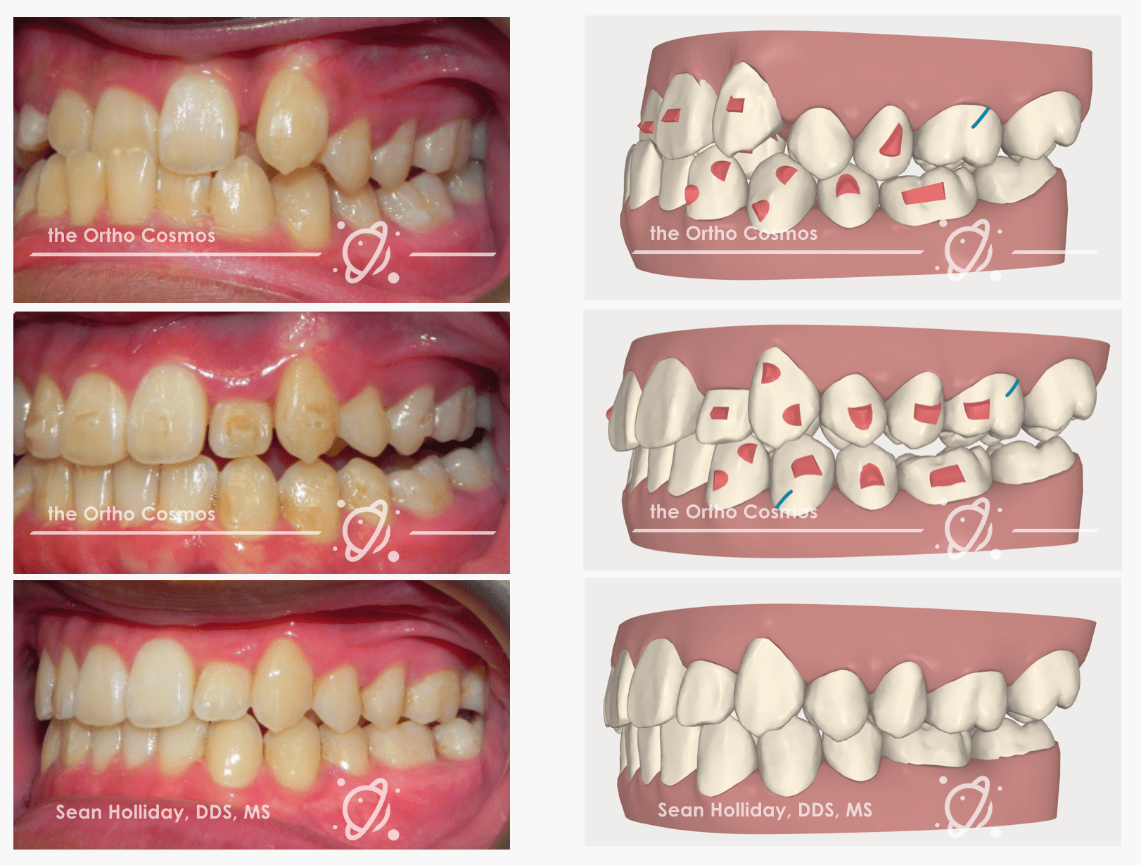 Posterior Openbites with Aligners The Ortho Cosmos