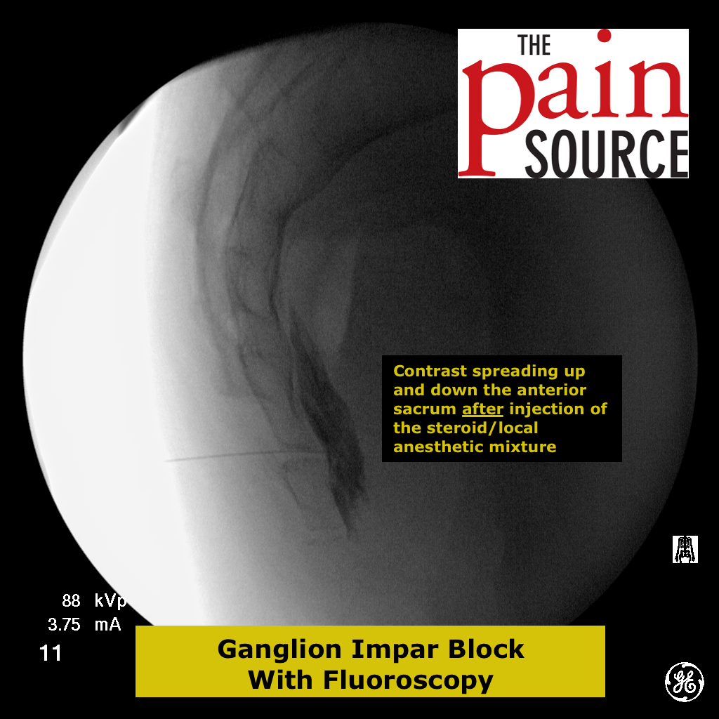Ganglion Impar Block with Fluoroscopy The Pain Source Makes Learning About Pain, Painless