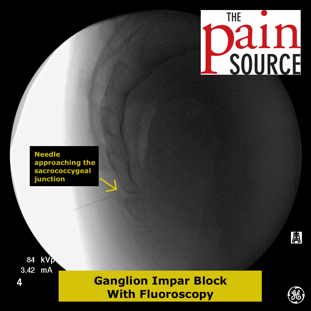 Ganglion Impar Block with Fluoroscopy The Pain Source Makes Learning About Pain, Painless