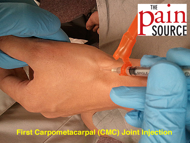 First Carpometacarpal Joint Injection Technique and Tips The Pain Source Makes Learning