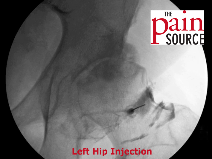VIDEO Hip Intraarticular Steroid Injection Under Fluoroscopy The Pain Source Makes Learning