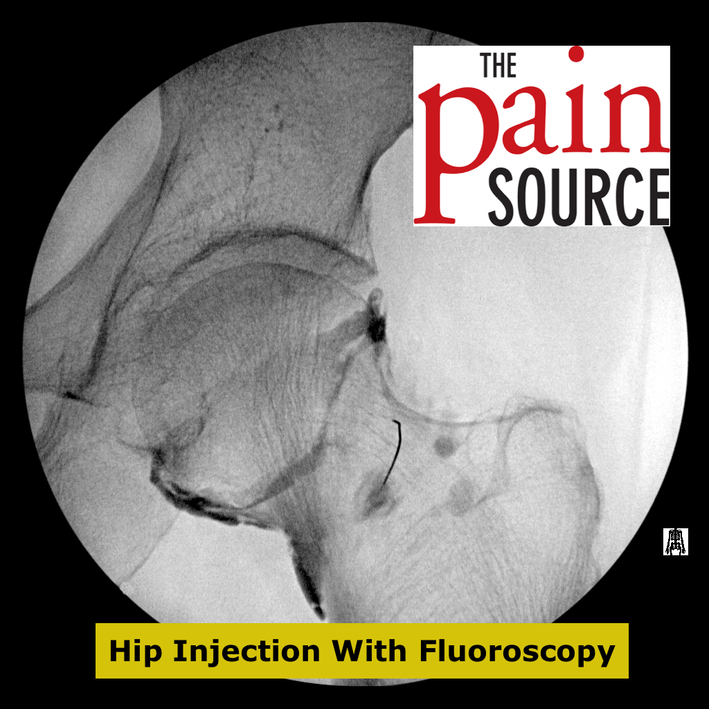 Hip Joint Injection With Fluoroscopy Technique and Tips