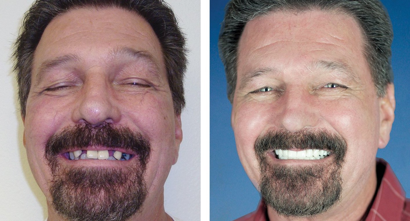Dental Implants The Point Dental in Lehi Utah